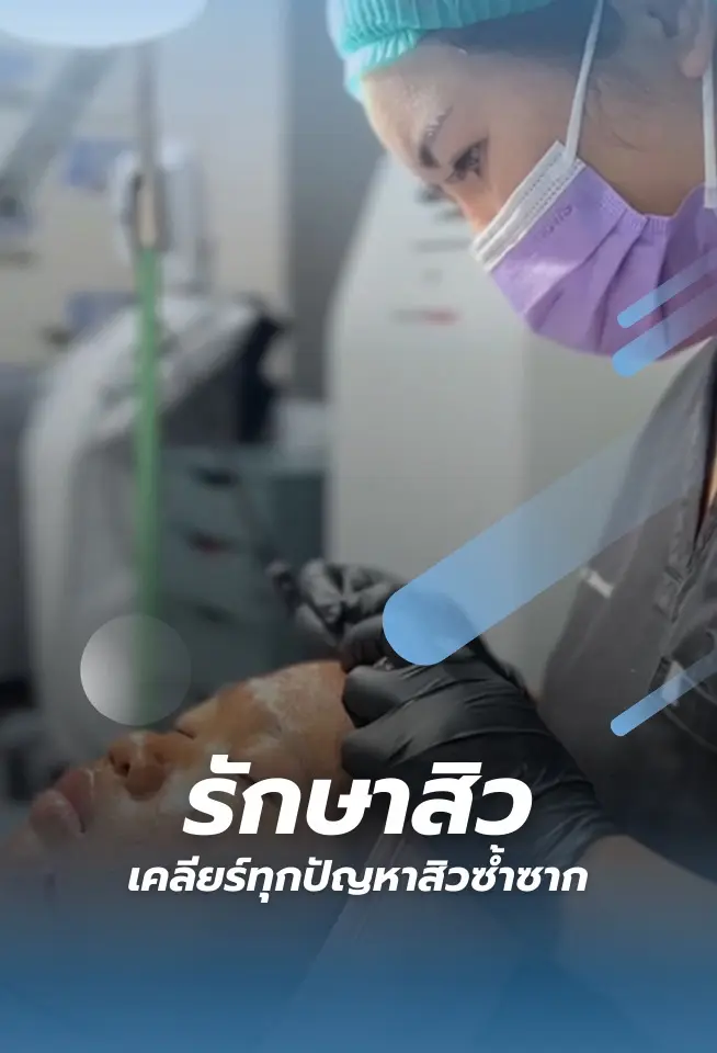 รักษาสิว